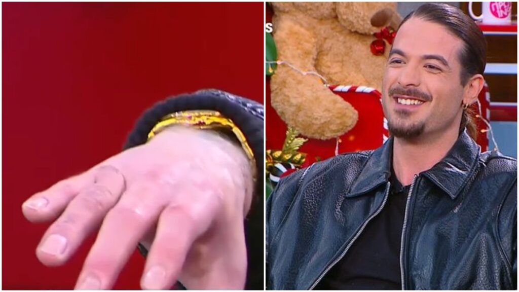 Άρης Μουγκοπέτρος: Συγκλονίζει για το ατύχημα με την κροτίδα